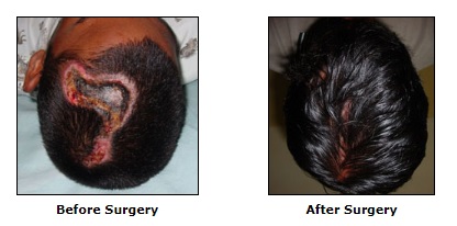 Reconstructive Surgery, Post Burn Deformities Surgery