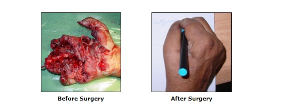 Bomb Blast Hand Surgery