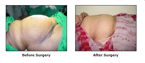 Abdominoplasty, Tummy Tuck Surgery, Cosmetic Surgery in visakhapatnam, Vizag