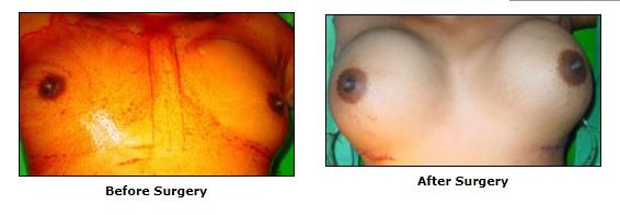 Cosmetic Surgery, Breast Augmentation Surgery