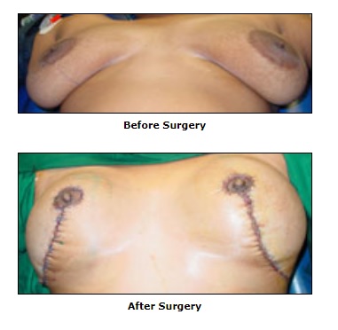 Cosmetic Surgery, Breast Lift Surgery