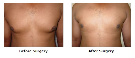 Cosmetic Surgery, Gynaecomastia, Male Breast Enlargement Surgery