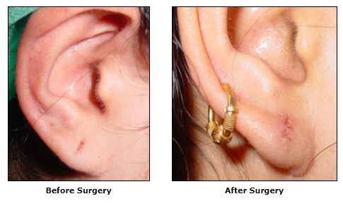 Cosmetic Surgery, Otoplasty, Ear Surgery