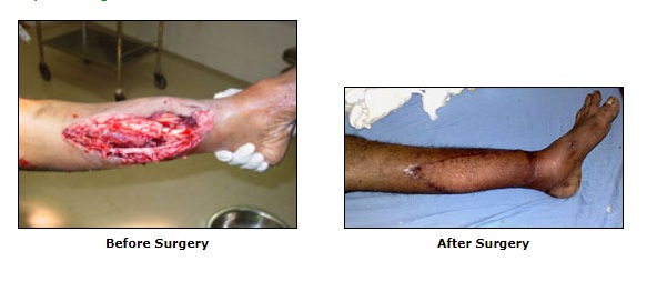 Compound Let Fracture Surgery