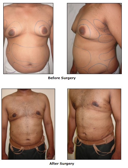 Liposuction is a cosmetic procedure designed to remove unwanted fat