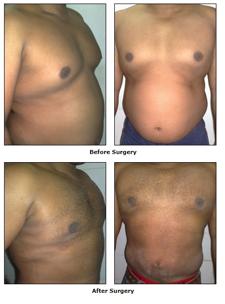Cosmetic Surgery, Liposuction Surgery