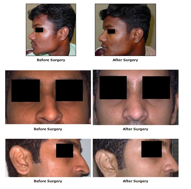 Cosmetic Surgery, Rhinoplasty Surgery