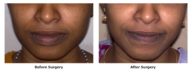 Cosmetic surgery, Lip Reduction Surgery