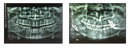 Mandible Fracture Surgery