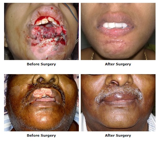 Nose and Lip Injury Surgery