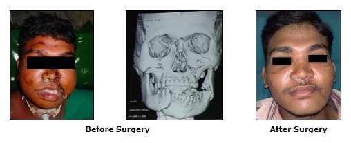 Panfacial Fractures