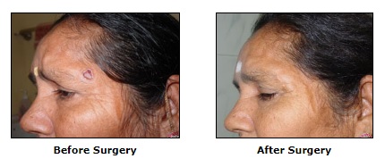 Cancer Reconstruction Surgery, Reconstructive Surgery