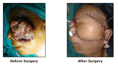 Cancer Reconstruction Surgery, Reconstructive Surgery